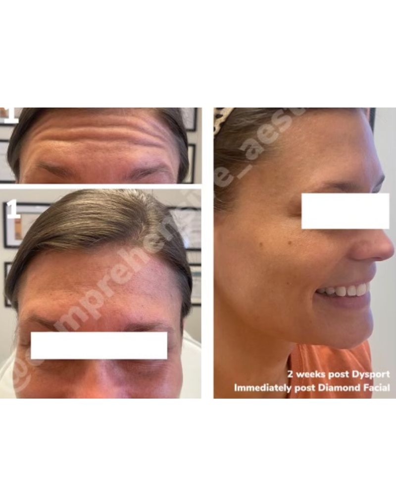 before-after-botox1.jpg