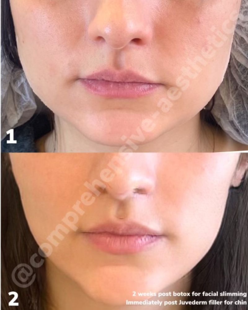 before-after-botox2.jpg