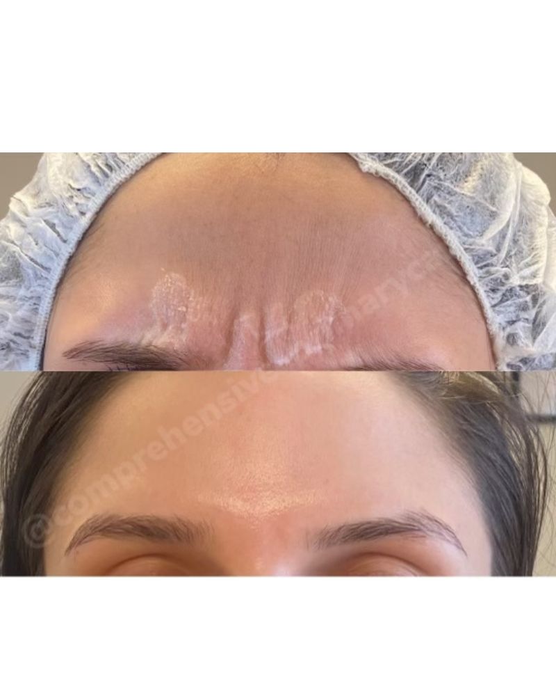 before-after-botox3.jpg