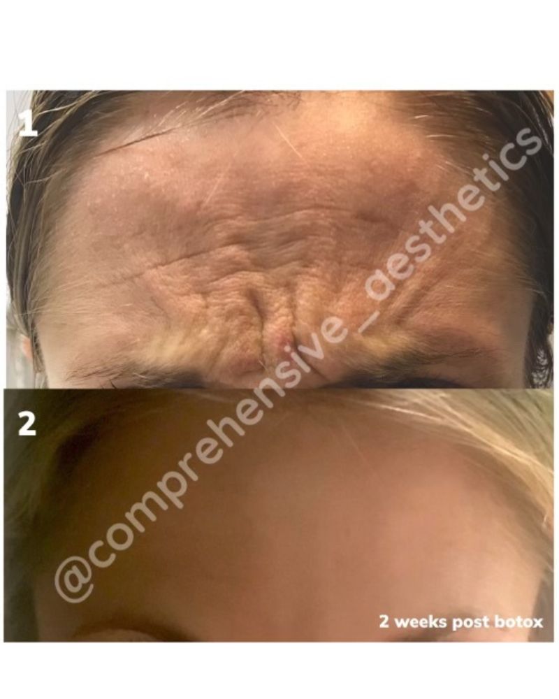before-after-botox4.jpg
