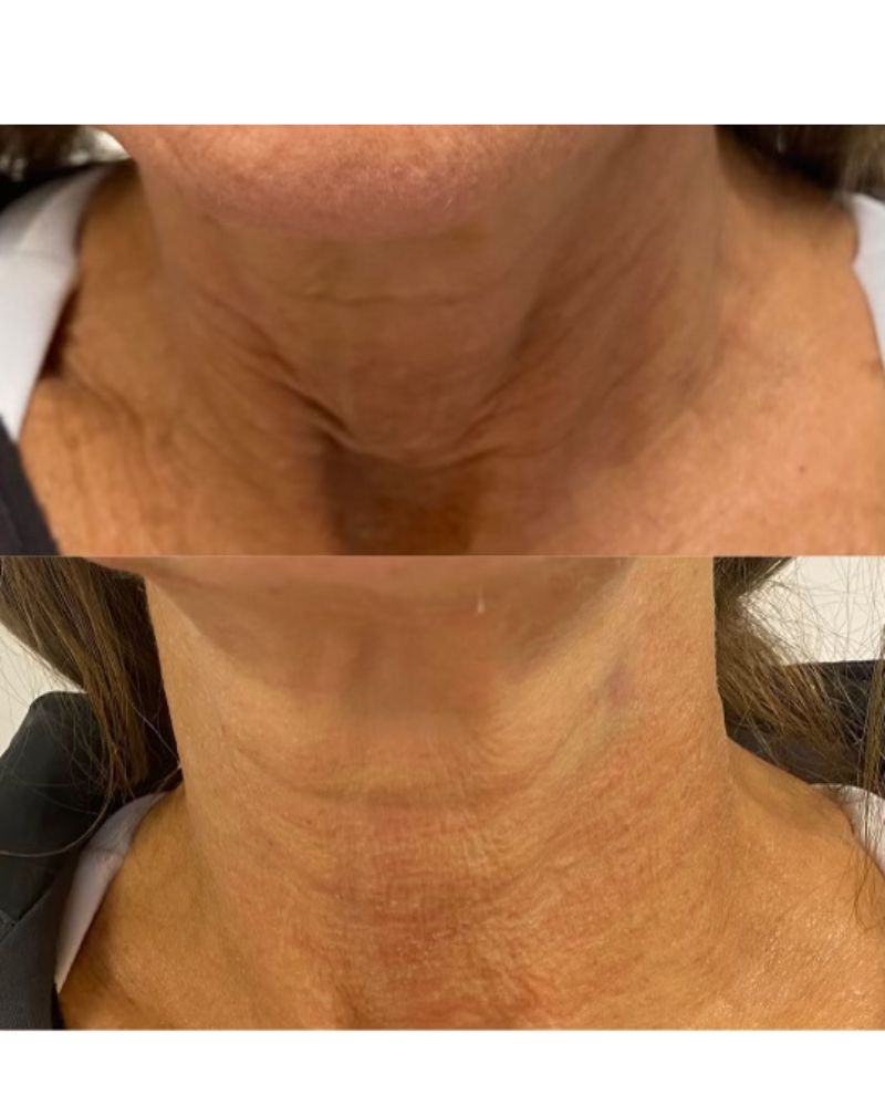 before-after-botox5.jpg