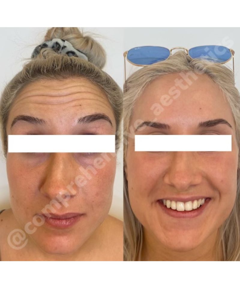 before-after-botox6.jpg