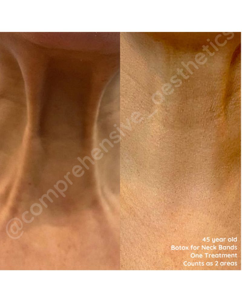 before-after-botox7.jpg