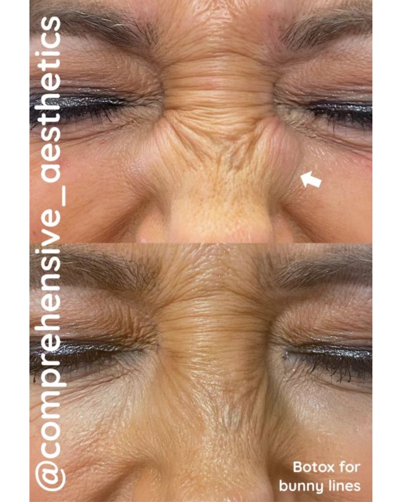 before-after-botox8.jpg
