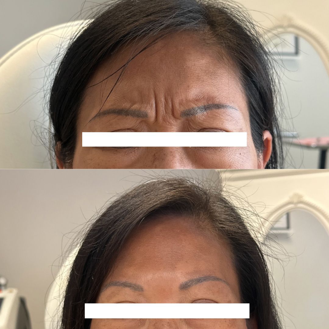 botox-before-after.jpg